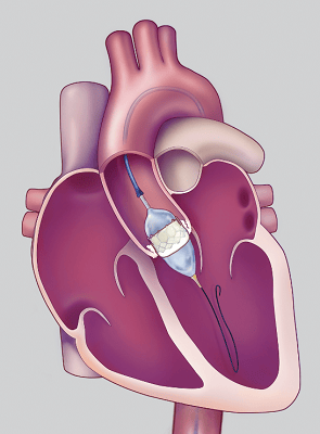 consider-tavr-to-treat-aortic-stenosis.png