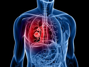 lung-cancer-screening.jpg