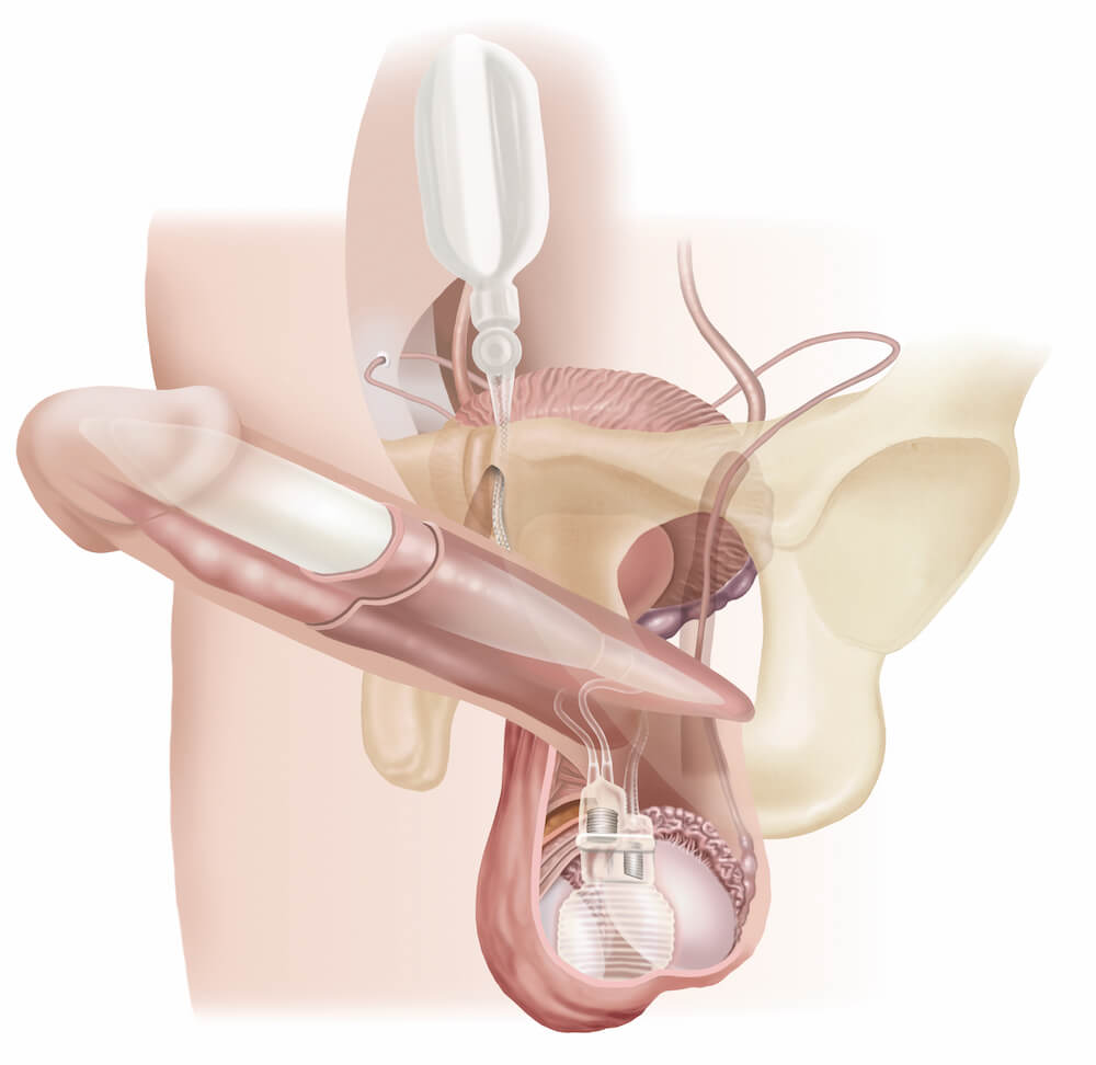 penile-implant-overview.jpg